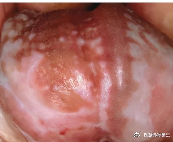 好奇，这个皮肤病居然会逐步阻挡羞羞之路