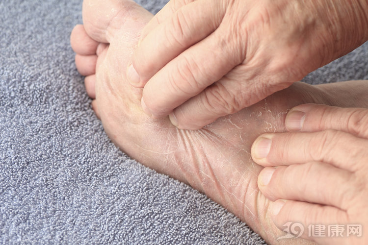 手脚一到夏天就脱皮发痒还长颗粒,手脚一到夏天脱皮起泡痒