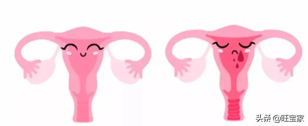 古代流产后需要清理子宫吗,中医对早期流产坐月子的建议