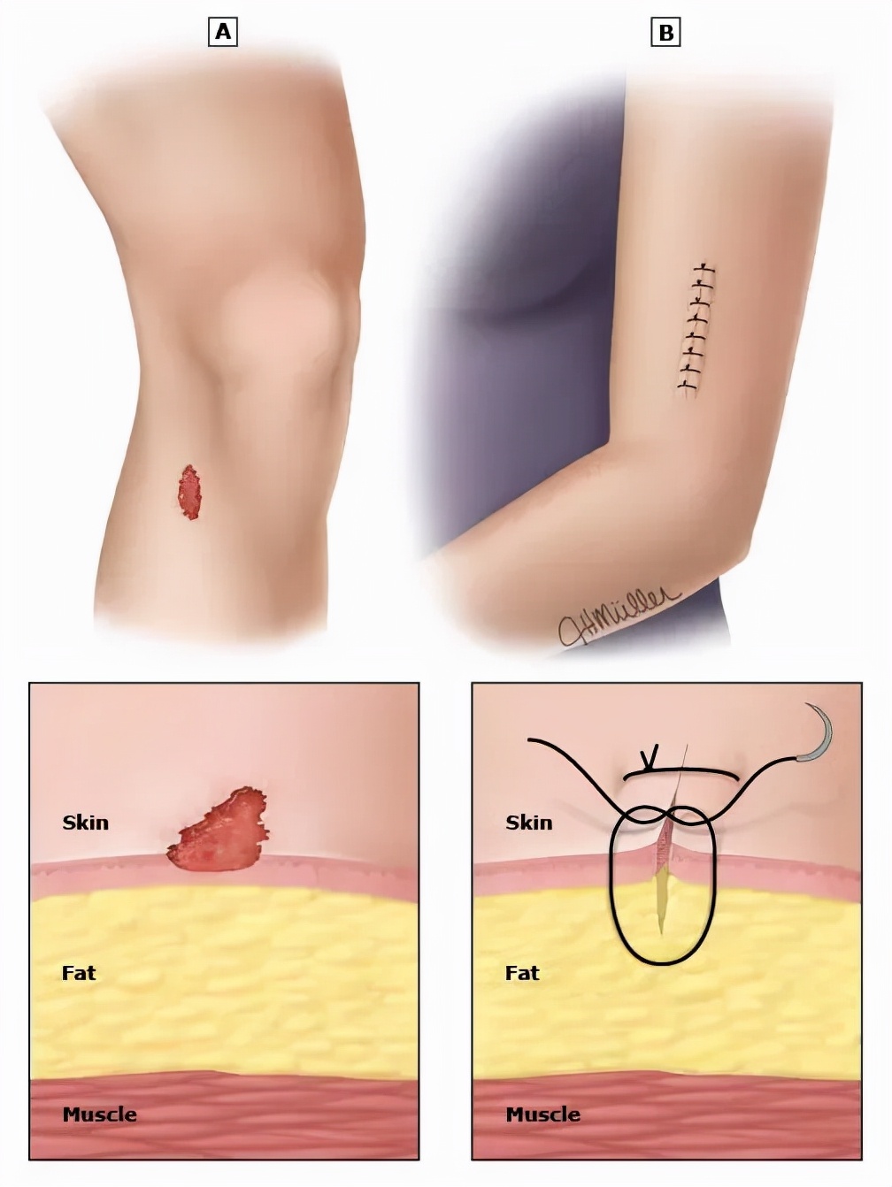 儿童受伤涂碘伏的视频,孩子受伤结痂可以用红霉素软膏吗