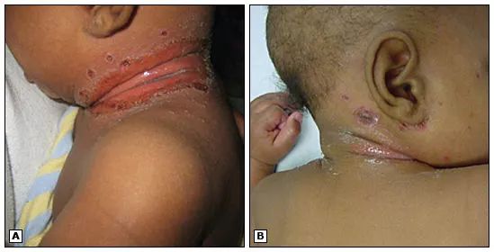 宝宝脖子淹了破皮了可以用茶油吗,宝宝淹脖子破皮能用红霉素软膏吗