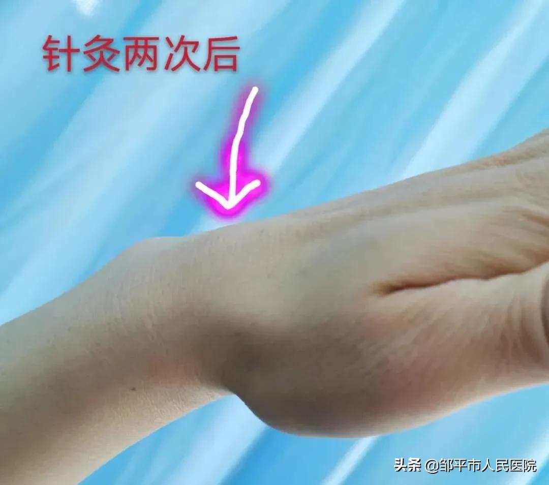 针灸三次就有效果还需要再扎吗,针灸治疗皮下囊肿