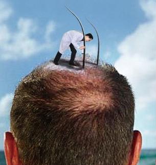 太“秃”然！80后成脱发主力，手术动辄数万元！记者*底卧**揭植发黑幕