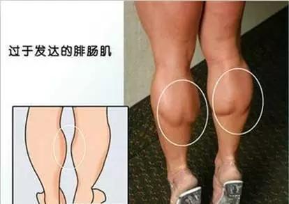 小腿粗壮弯曲不直是什么原因,小腿太粗是经常跑步的原因吗