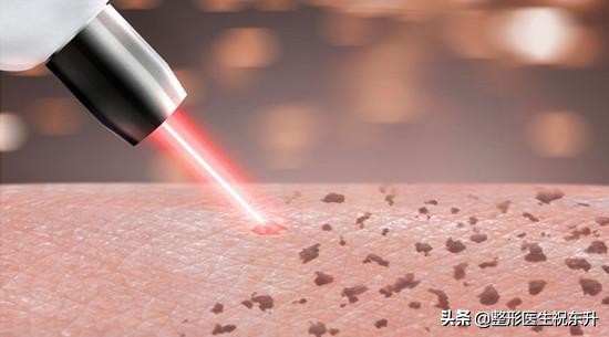 该不该去做皮秒激光手术,皮秒激光到底好不好