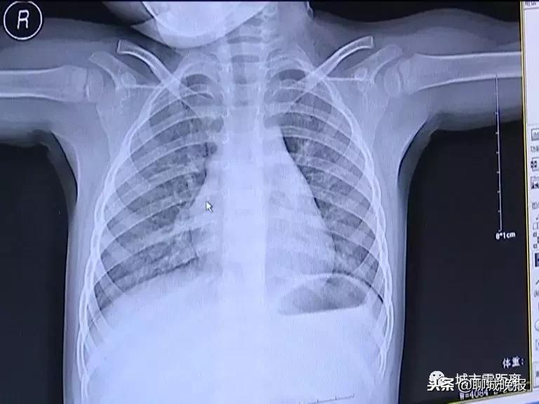 7岁女童高烧不退怎么办,小儿不明原因高烧案例