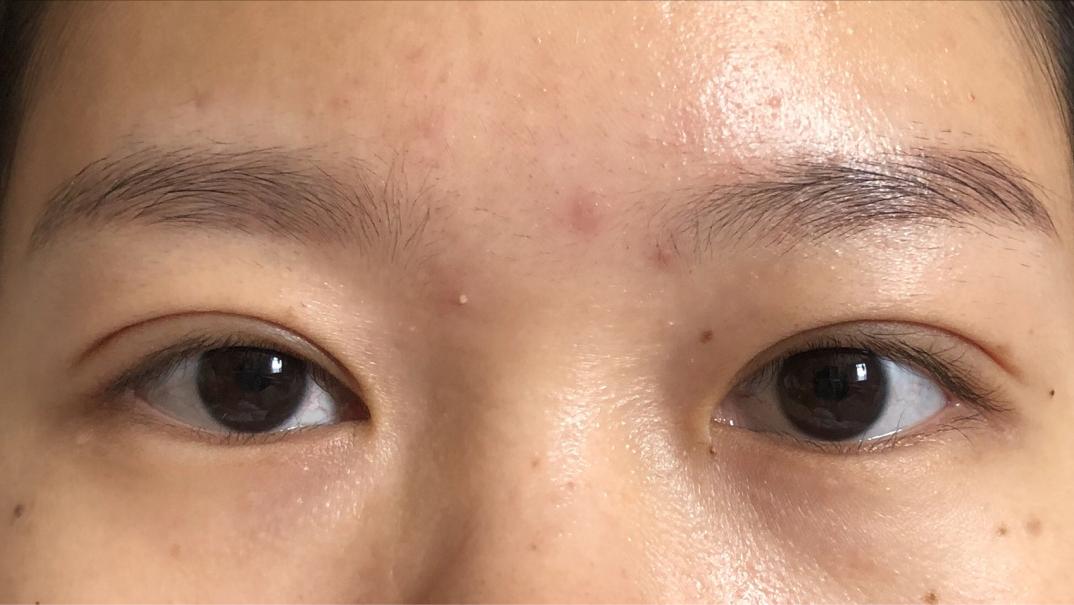 做个双眼皮手术30000块钱贵吗,做双眼皮花了15000贵了吗