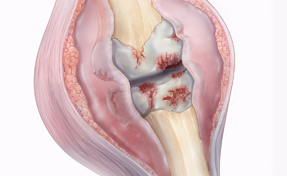 火针治疗膝关节内侧副韧带炎,治疗膝关节骨性关节炎最好的方法