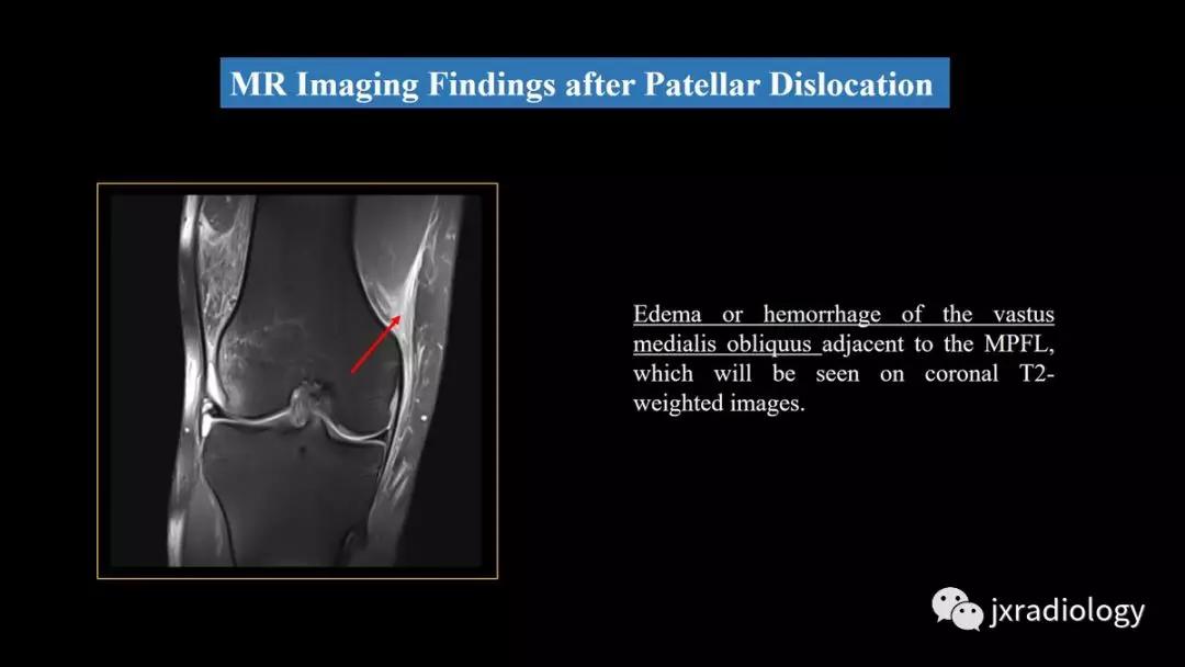 髌股关节失常磁共振看什么,髌股关节混乱的影像评估