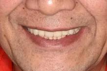 佛山种植牙齿全过程,南京牙齿种植案例分享