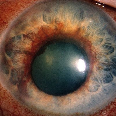 中年人需预防的疾病,中老年人预防眼睛疾病的最佳方法