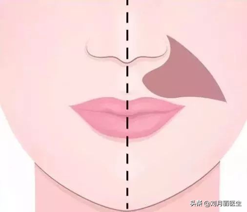 修复苹果肌改善法令纹,改善法令纹的面部运动