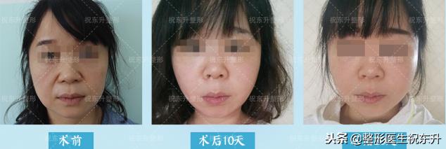 脸松弛下垂法令纹做什么医美手术,法令纹苹果肌下垂做什么手术