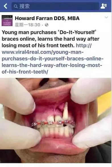 超便宜隐适美,网上买隐适美靠谱吗