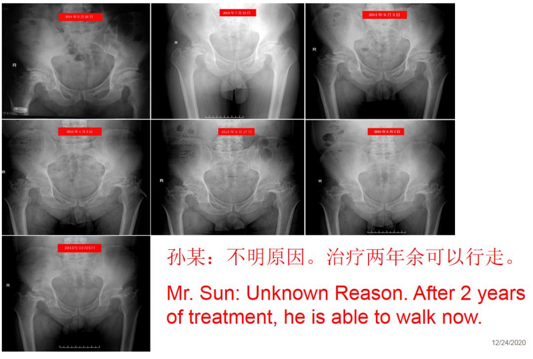 对股骨头缺血性坏死疼痛的治疗体会