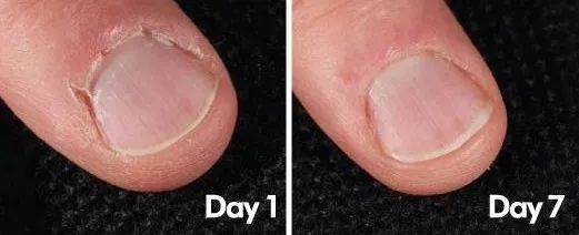 手脚干裂倒刺怎么治疗,手脚经常脱皮开裂最佳治疗方法