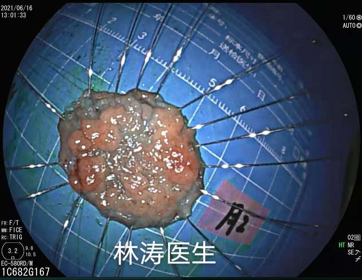医学博士的忠告,医学博士曝光肿瘤过度治疗