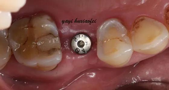 种植牙手术流程图解,口腔种植牙护士手术配台流程