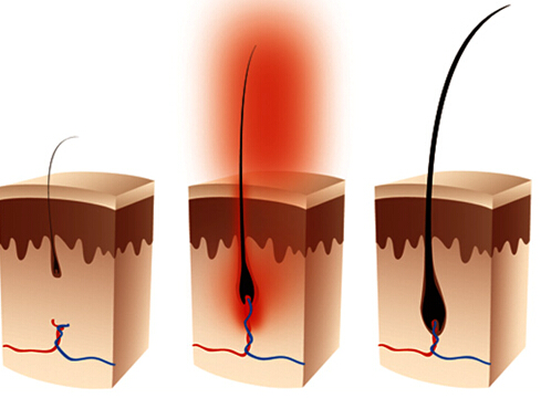 毛囊退化的原因和治疗方法,毛囊萎缩还能长出头发吗