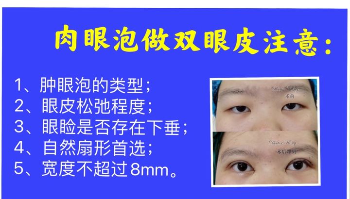 肿眼泡建议割双眼皮吗,肿眼泡做双眼皮怎样才会成功
