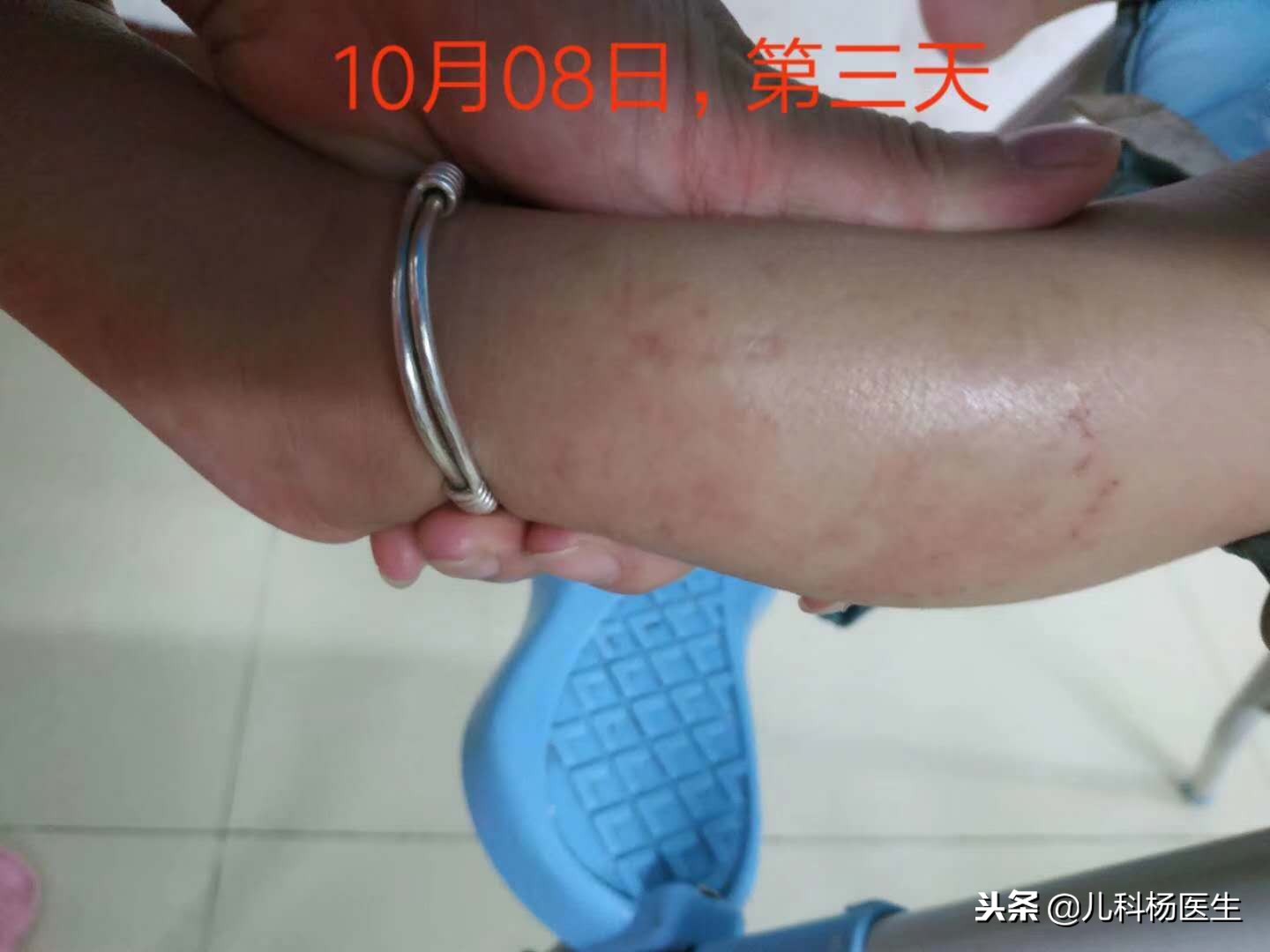 宝宝湿疹涂了炉甘石又严重了,宝宝湿疹抹了药更严重了