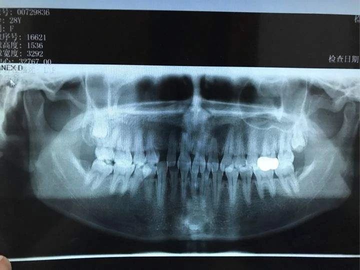南宁牙齿矫正的每一个详细步骤,儿童的牙齿矫正的步骤