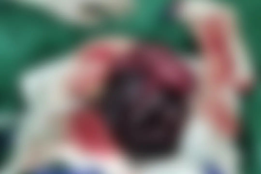 儿童小肠切除一部分以后会生长吗,儿童小肠切除后遗症