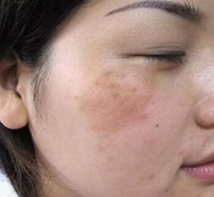 脸上有斑用什么护肤品祛斑效果好,40岁女人脸上长斑怎样有效祛斑