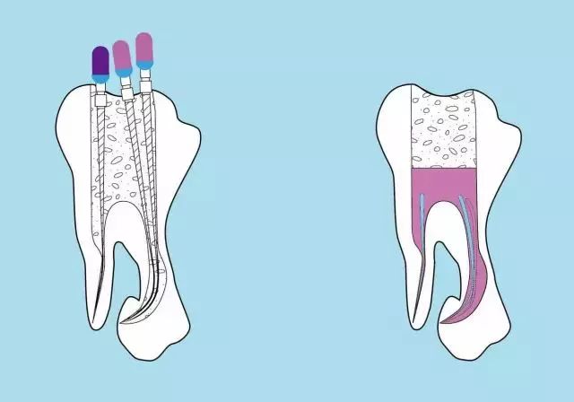 根管治疗后牙齿劈裂怎么办最好,戴冠后牙会不会劈裂