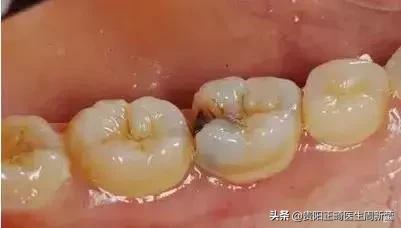 牙齿以前齐现在不齐是什么原因,牙齿排列整齐牙缝大前门牙凸