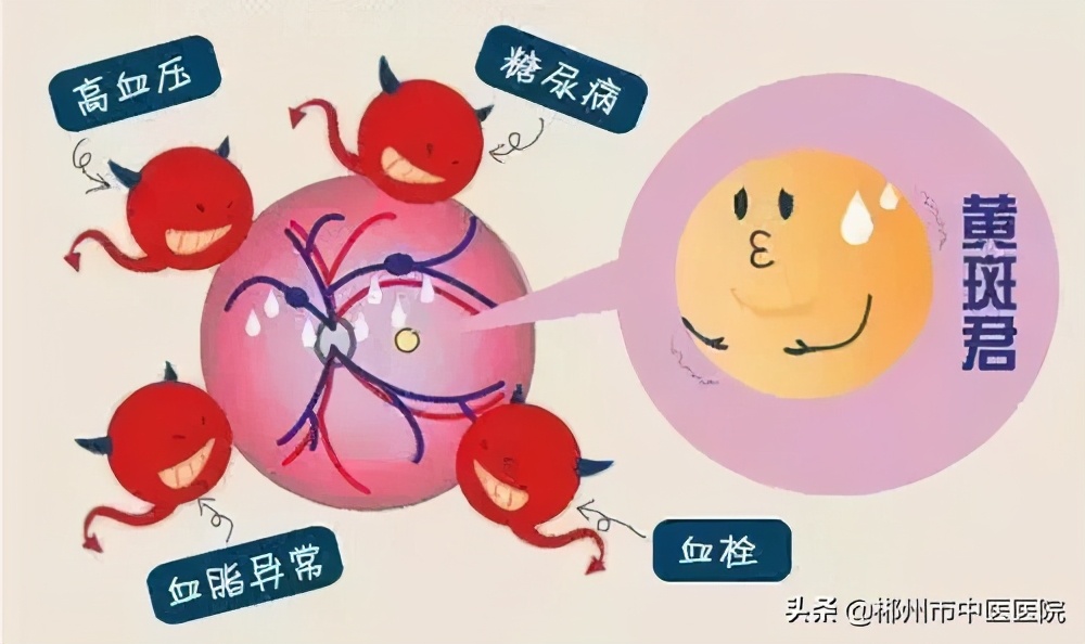 谨防视力杀手——视网膜静脉阻塞