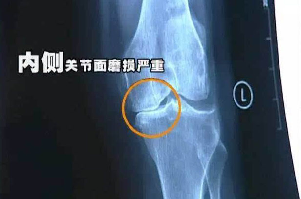 膝关节退变怎么办,膝关节易退化怎么办