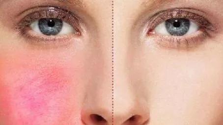 皮肤敏感怎么自愈的,皮肤干燥敏感用什么水补水比较好