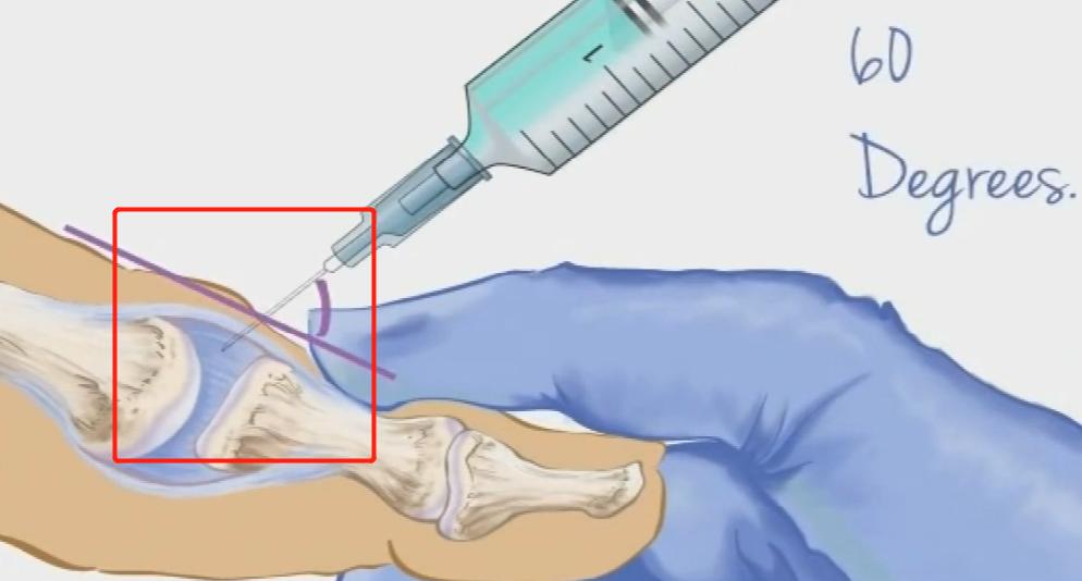 手指腱鞘炎怎么治好得快,手指腱鞘炎怎么办最快最有效