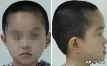 乳牙地包天会自动好吗,乳牙地包天矫正活动器