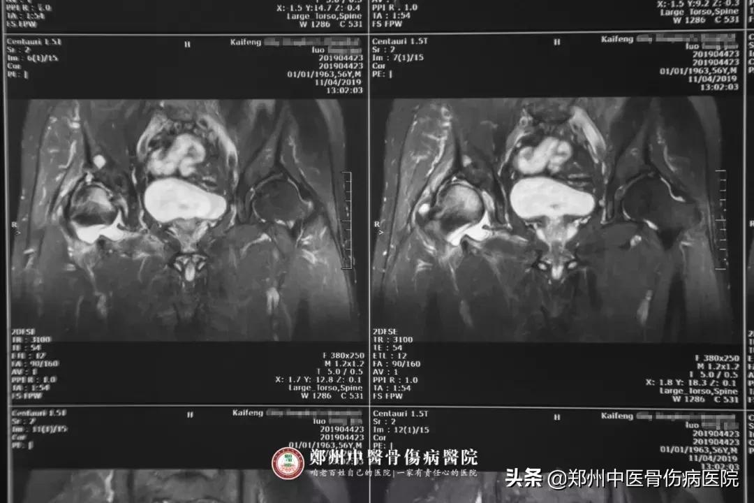 股骨头坏死钻孔减压后的康复视频,早期股骨头坏死用什么药最有效