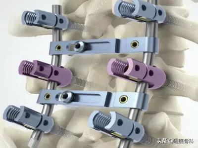 骨折打了钢筋了要取出来吗,骨折打了钢板能定残吗