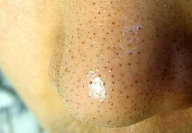 鼻子上黑头怎么简单去除,鼻子上顽固黑头怎么去除