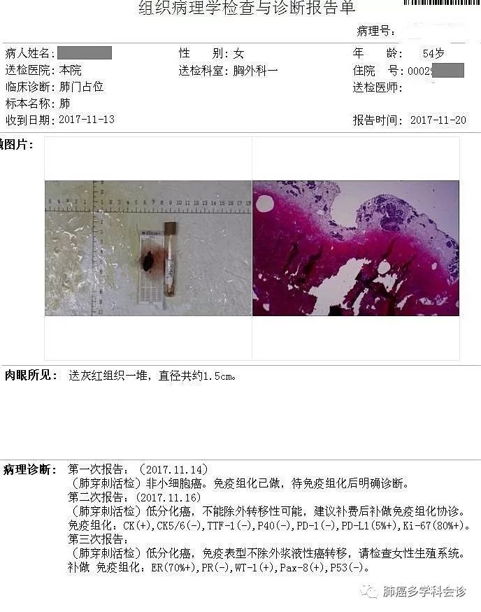 肺癌淋巴结转移和淋巴癌区别,肺和气管之间有恶性淋巴转移