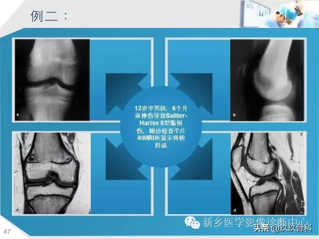 骨骺损伤x线表现,骨骺损伤磁共振表现