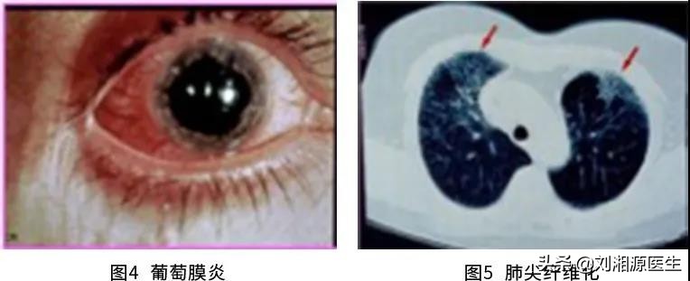 怀孕如何避免强直性脊柱炎,免疫修复治强直性脊柱炎