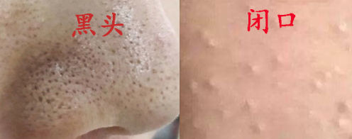 你们的痘痘最后都是怎么完全好的？反正我是用了这个方法才好的