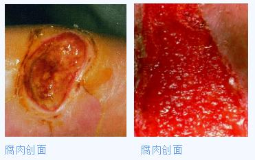 手术伤口愈合后怎么护理好得快,怎么护理伤口的视频