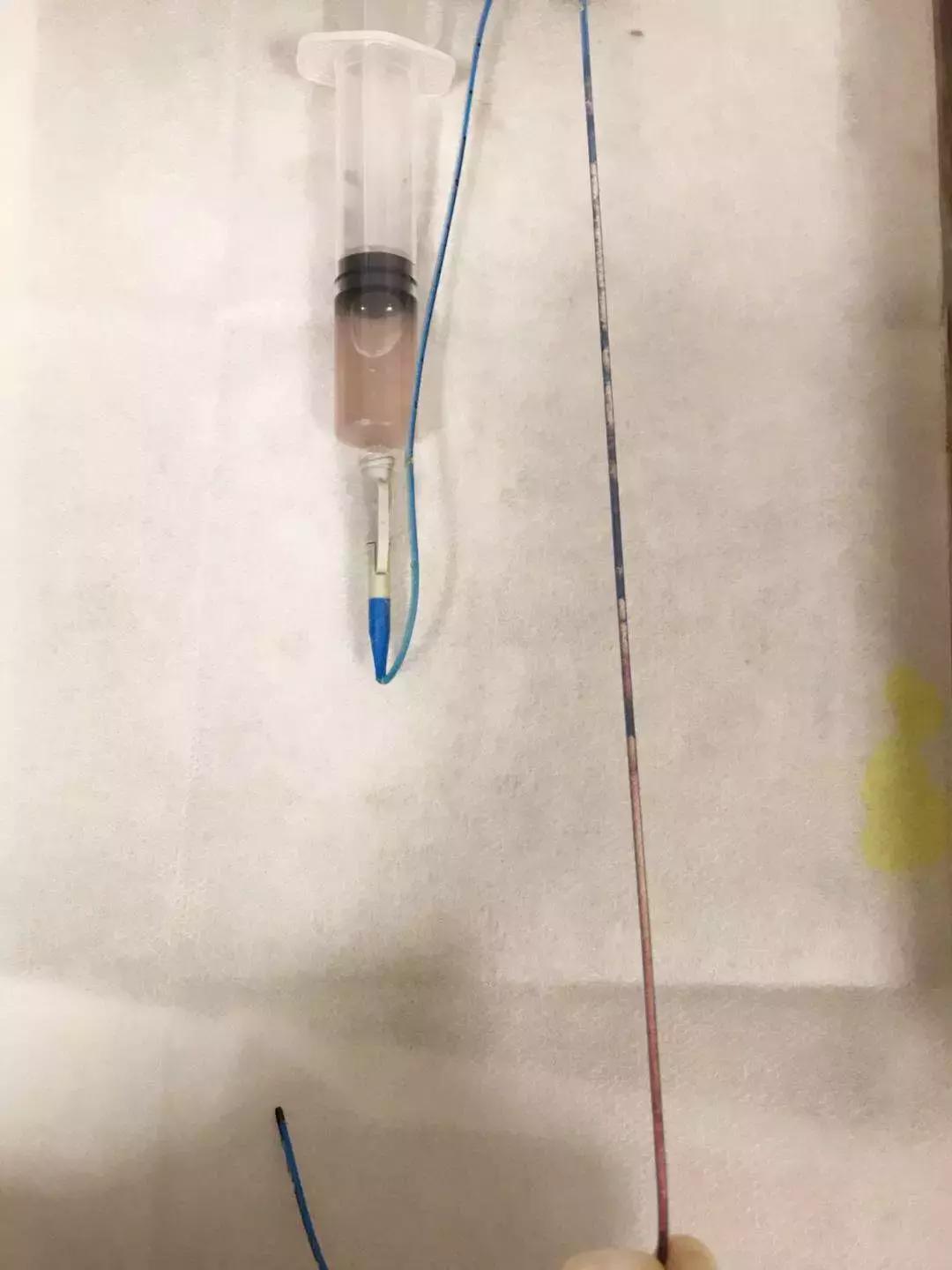 picc发生堵管时的处理方法,picc内置管堵了是什么原因