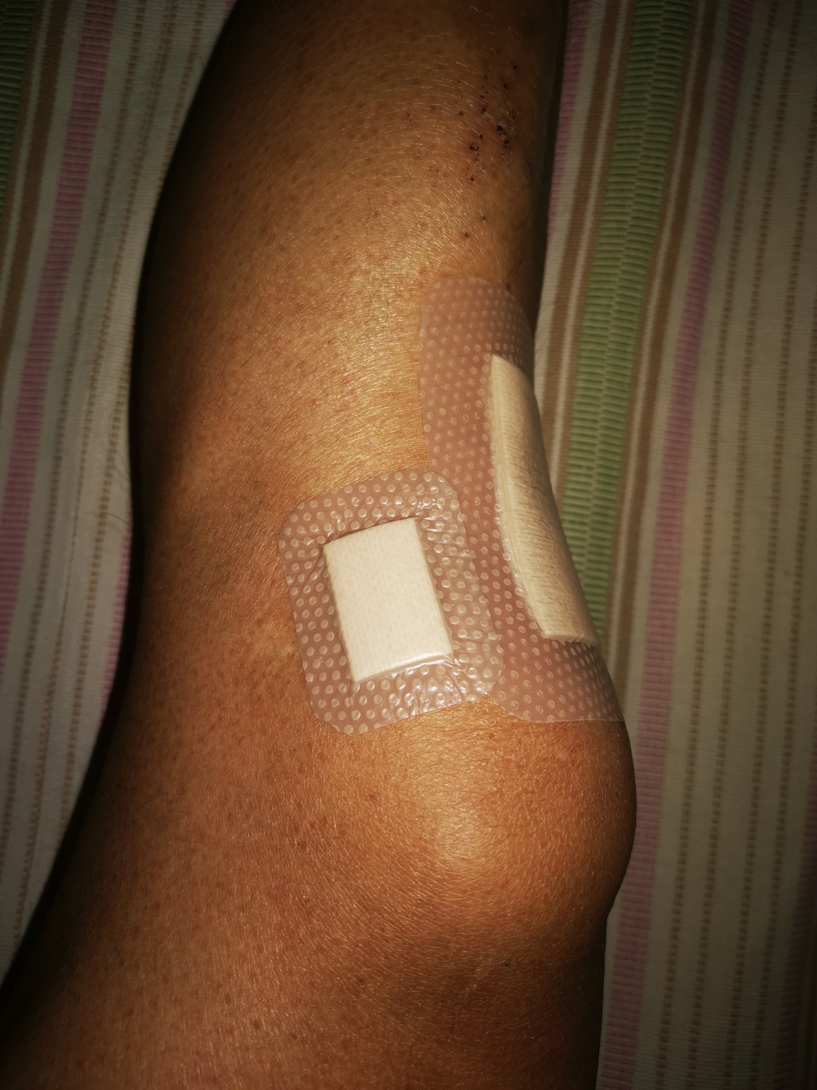 瑞典墨尼克疤痕贴,瑞典墨尼克敷料