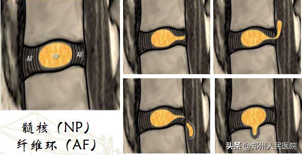 对骨科微创技术的认识,骨科手术与保守治疗对比