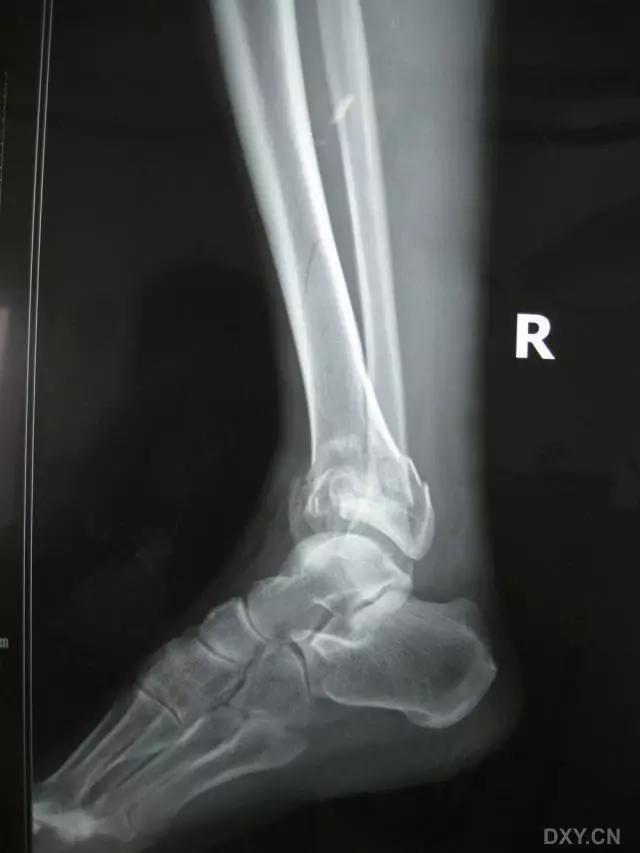 所有骨折都叫什么名字,骨折的名称有哪些