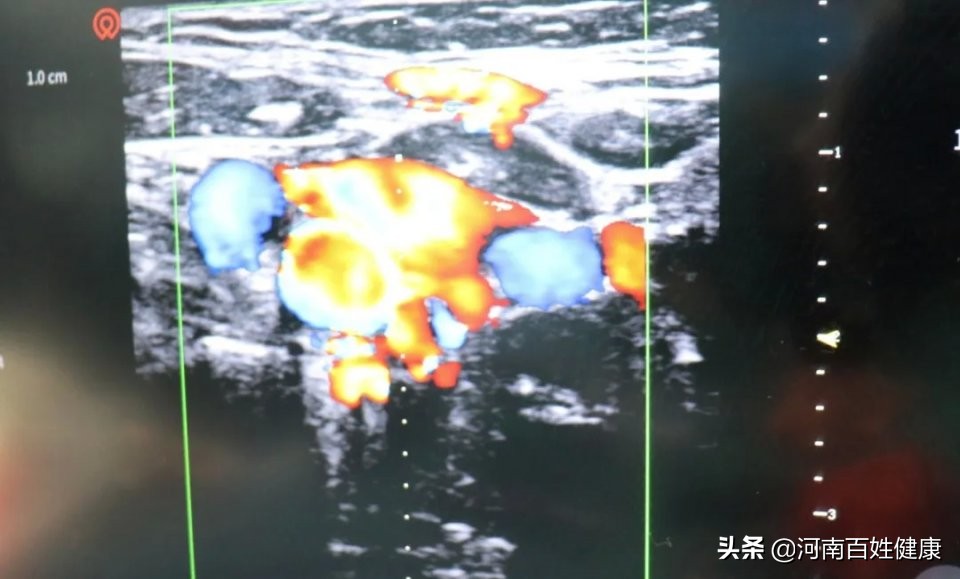 生小孩产妇头部血管破裂,产妇生产难产危急获救的新闻报道