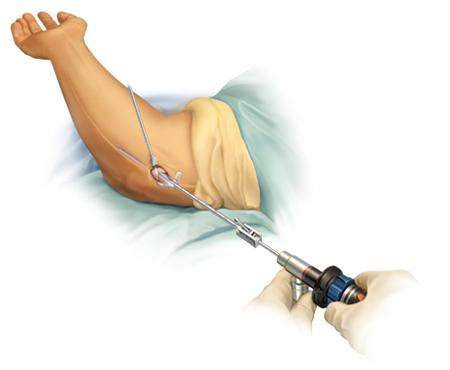 “医生，我胳膊肘伸不直了，还用不了筷子了，我是怎么了啊？”