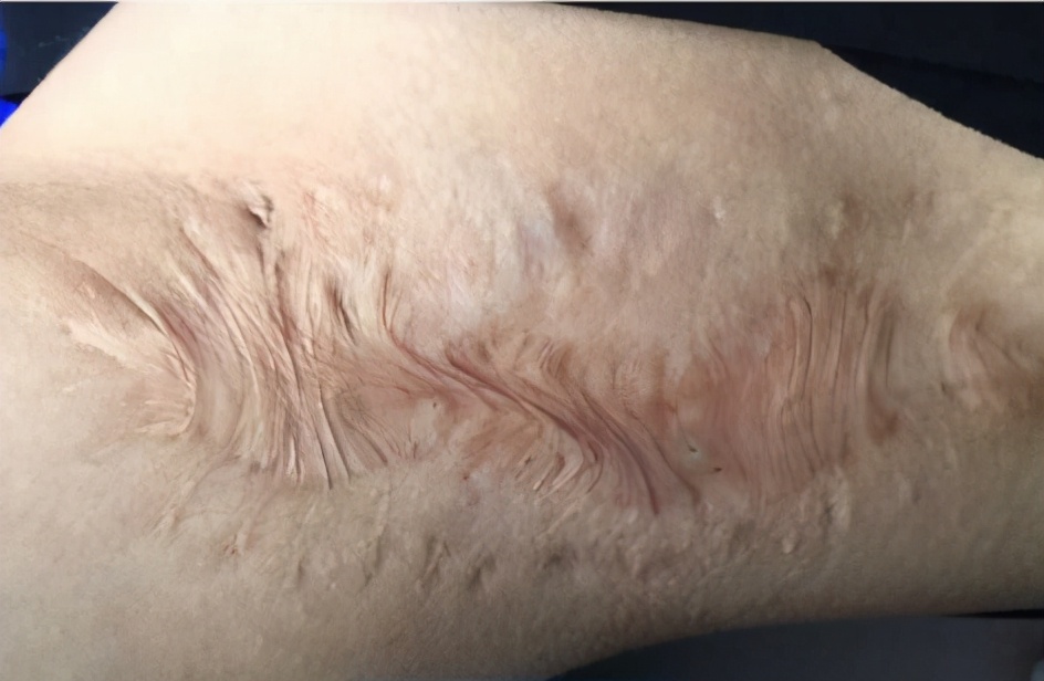 烧烫伤疤痕去除最好办法,烧烫伤疤痕怎么修复